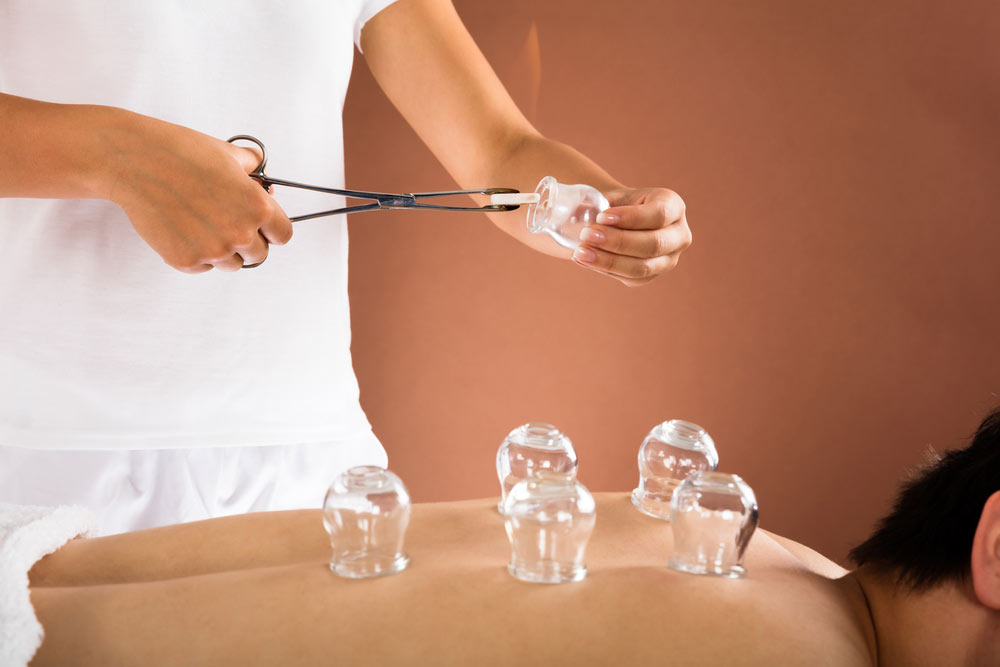 cupping therapy sydney